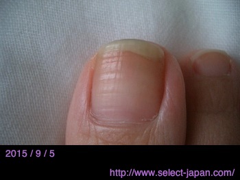 手と足の親指で実験 ドクターネイル ディープセラムの効果 爪の美容液 Select Japan Closet