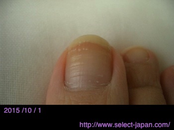 手と足の親指で実験 ドクターネイル ディープセラムの効果 爪の美容液 Select Japan Closet